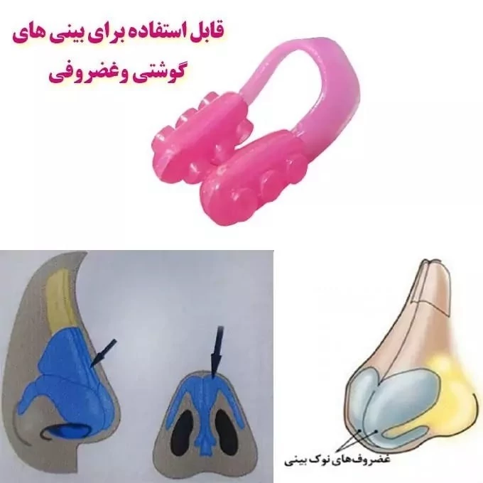 گیره فرم دهنده و کوچک کننده بینی نوزاپ